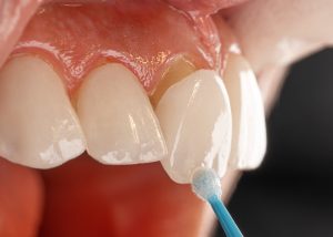 a tooth with a blue toothbrush in it